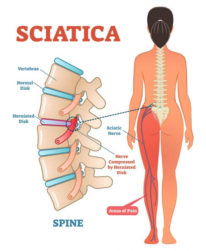 Sciatic Nerve Irritation